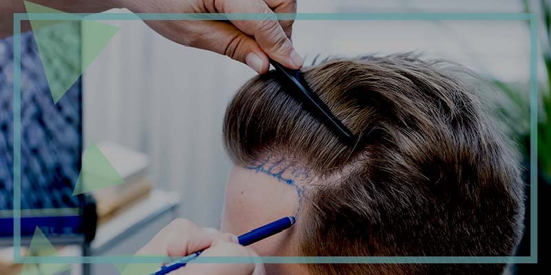 What will the future of hair transplantation be?