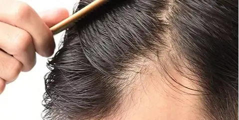Greffe de cheveux sans rasage